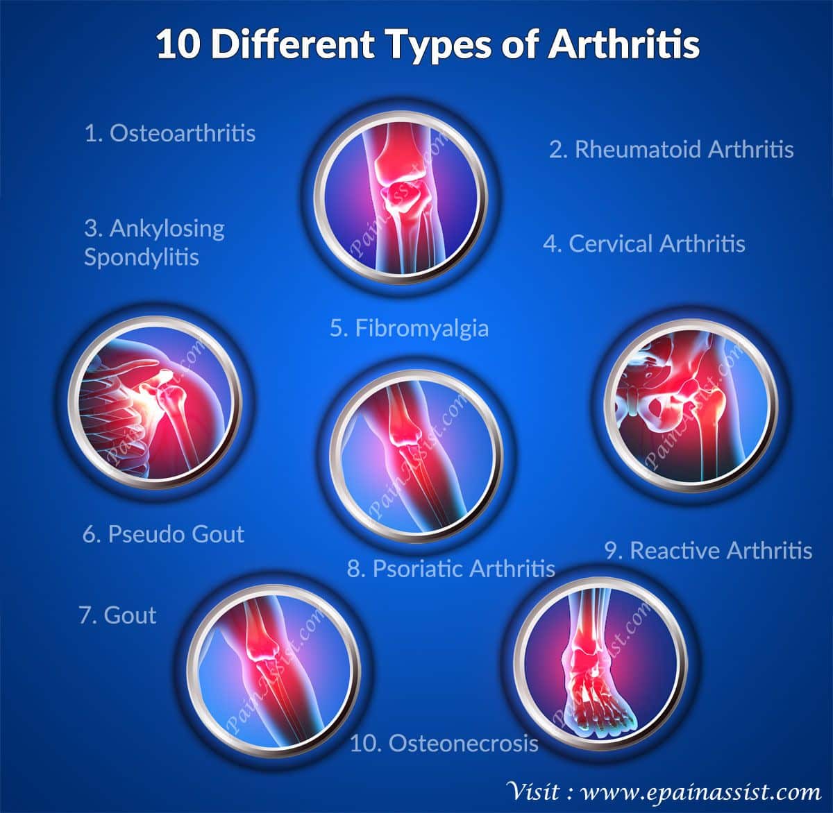 10 Different Types of Arthritis Read  http://www.epainassist.com ...