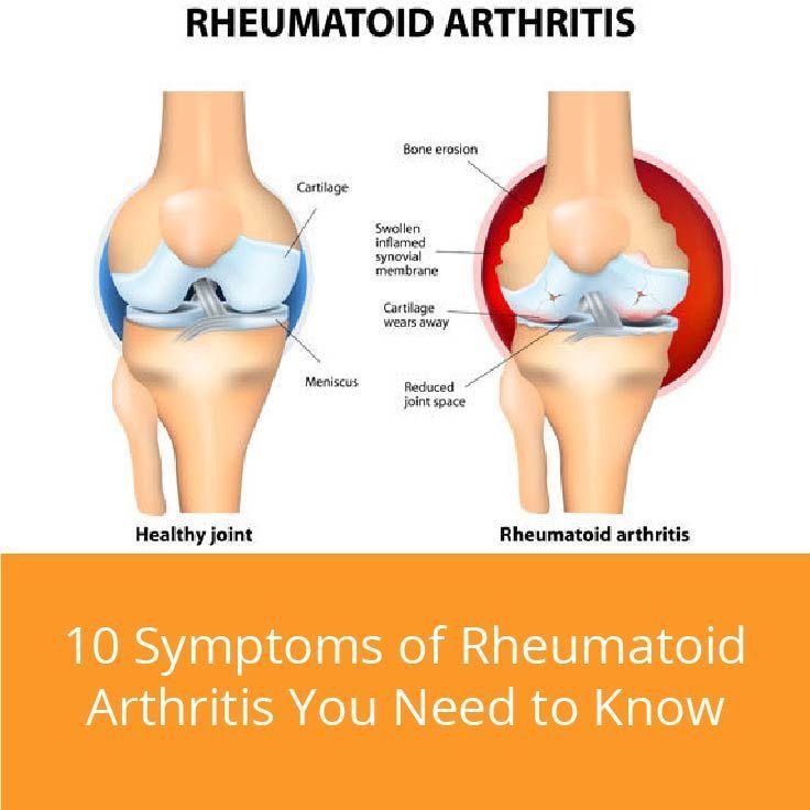 10 Symptoms of Rheumatoid Arthritis You Need to Know