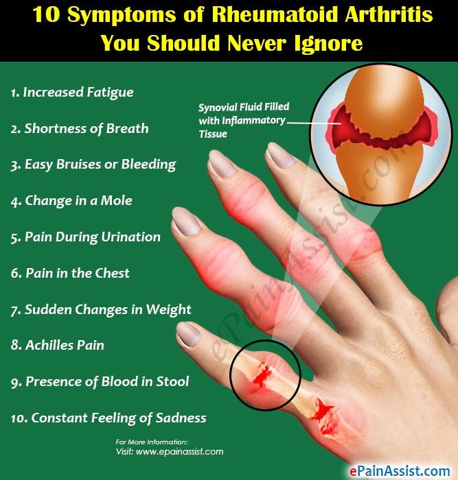 10 Symptoms of Rheumatoid Arthritis You Should Never Ignore