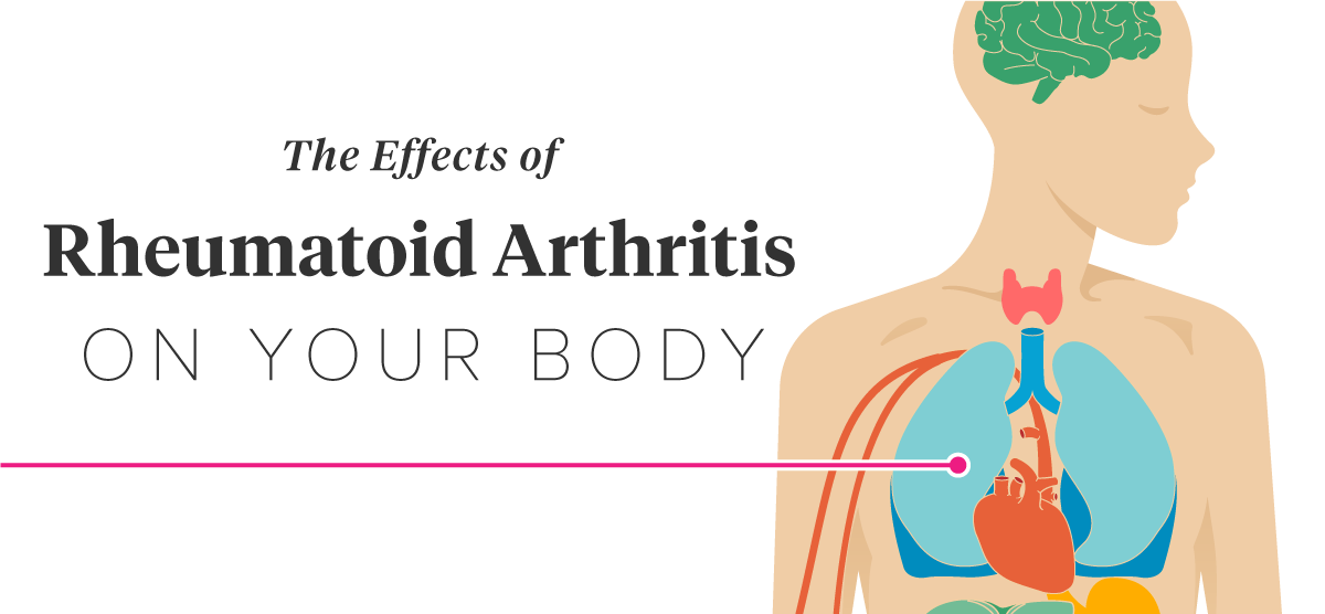 11 Effects of Rheumatoid Arthritis on the Body