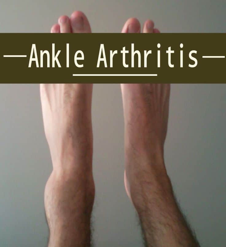 12 best Arthritis Pain Relief images on Pinterest