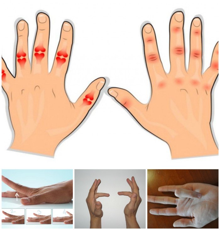 12 Simple Exercises And Home Remedies To Relieve Arthritis ...