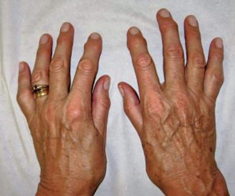 +14 Osteoarthritis With Rheumatoid Arthritis