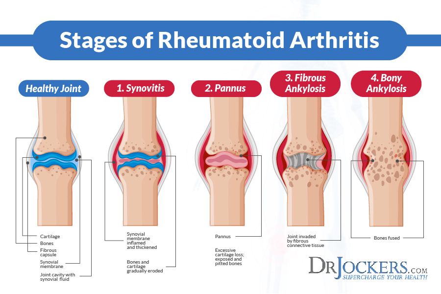 20 Ways to Beat Rheumatoid Arthritis Naturally ...