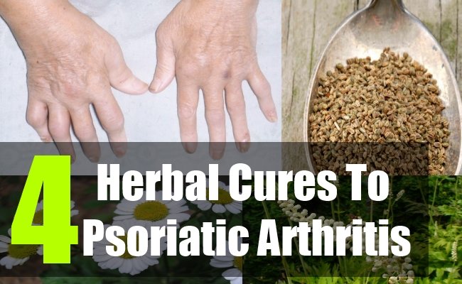 4 Incredible Herbal Cures For Psoriatic Arthritis