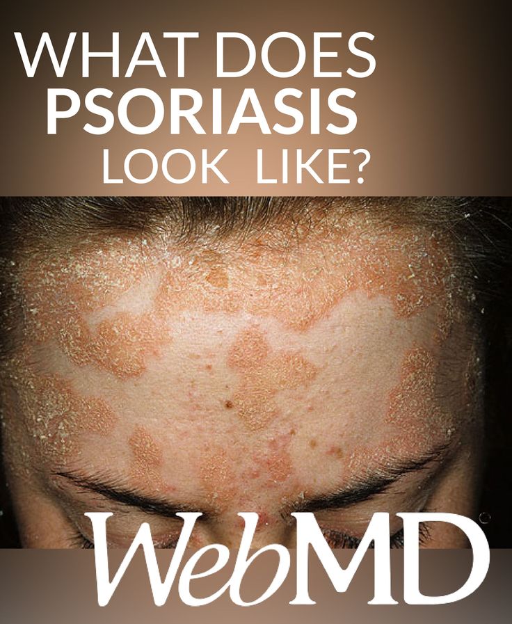 41 best images about Psrioriasis and Skin issues on Pinterest