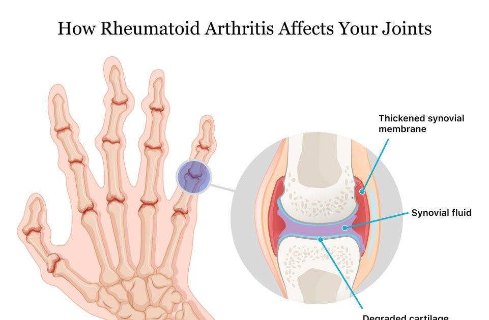 46+ Can Arthritis Be Cured Permanently? Pictures