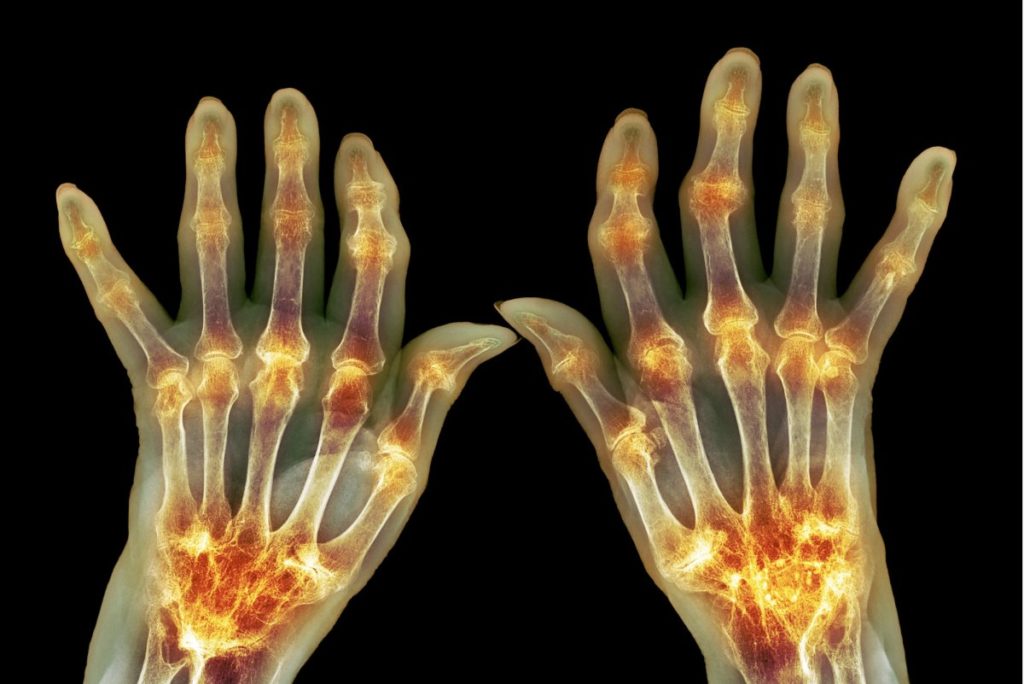 5 Easy Ways to Help You Manage Hand Osteoarthritisâ¦