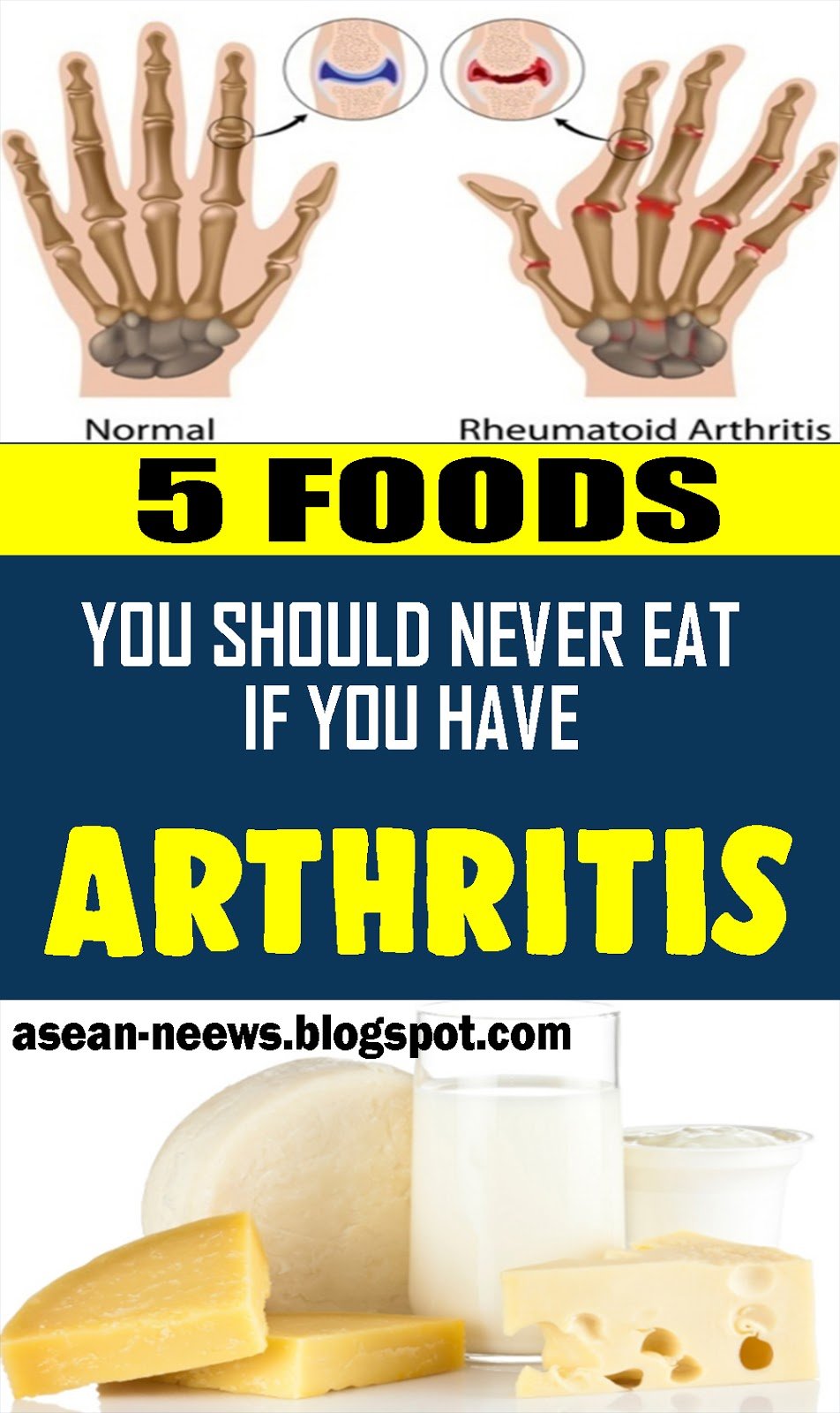 5 Foods You Should Never Eat If You Have Arthritis