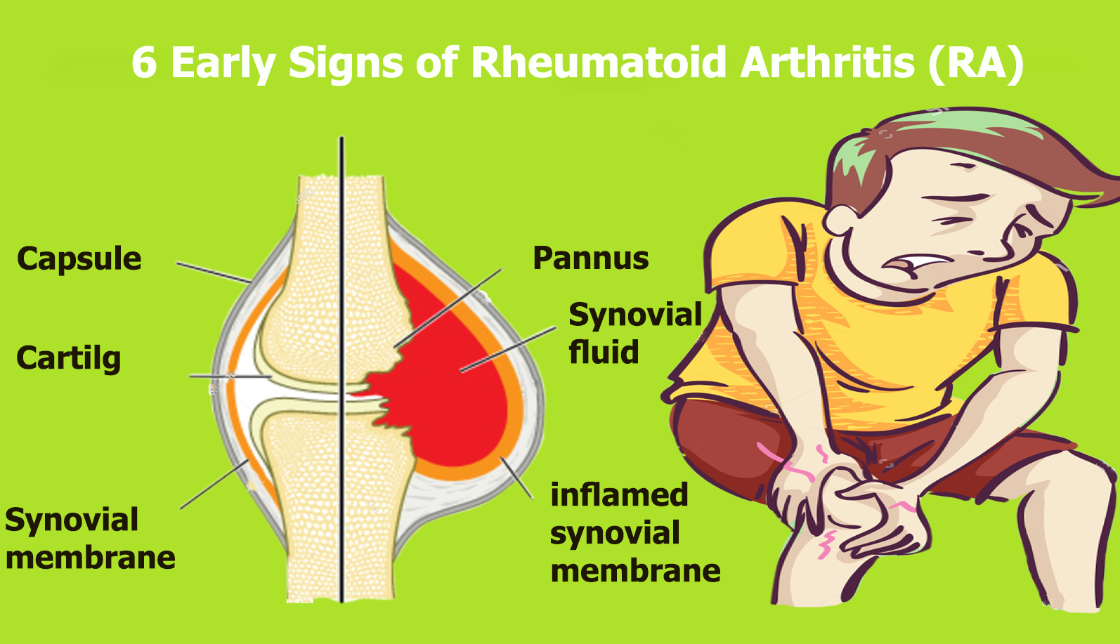6 Early Signs of Rheumatoid Arthritis (RA)