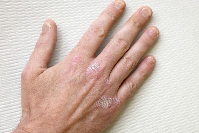 6 Signs of Psoriatic Arthritis  Mega Bored