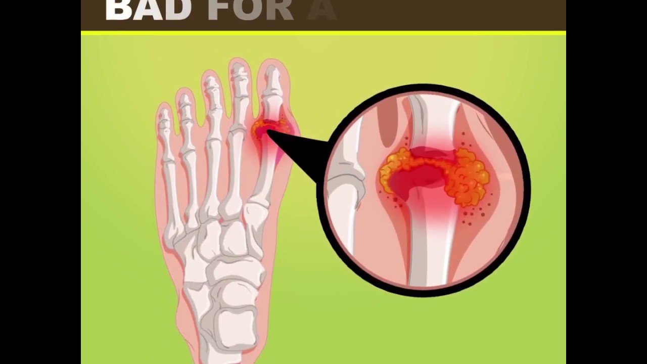 7 Foods That are Bad for Arthritis