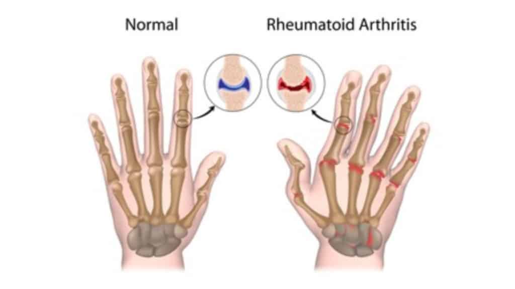 7 Supplements That Decrease Rheumatoid Arthritis Pain
