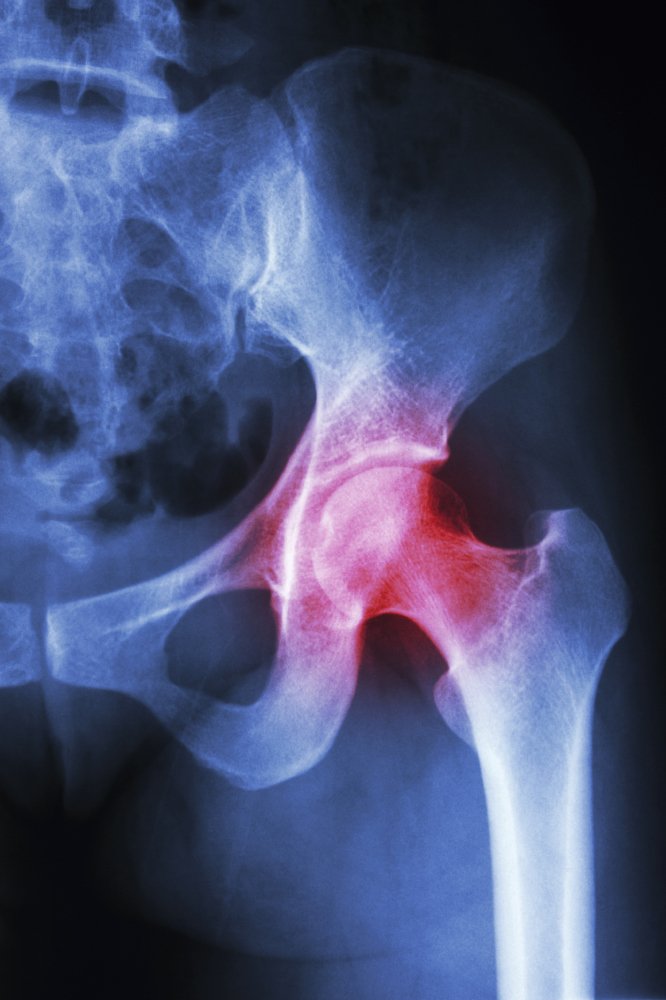 7 ways to treat hip arthritis