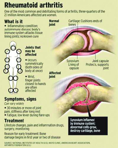 8 signs and symptoms of rheumatoid arthritis