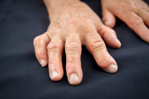 9 Treatments for Arthritis of the Hands