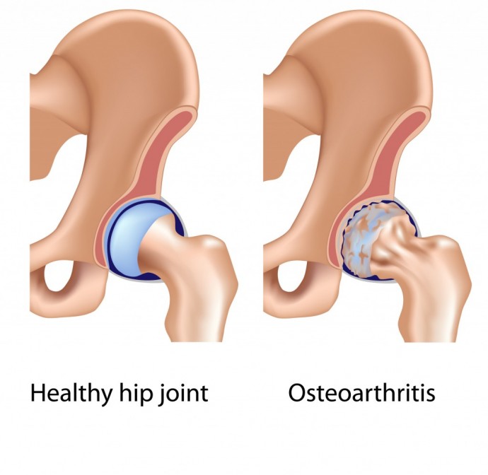 A Brief Look At Osteoarthritis â Symptoms &  Causes â PM Press