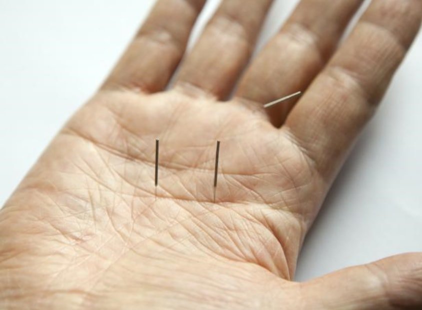 Acupuncture Help Arthritis