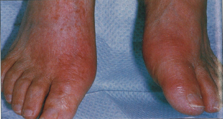 Acute Gouty Arthritis