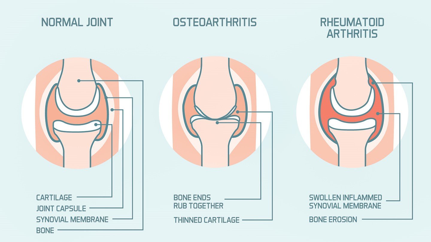 Advantages and Disadvantages Of Over the Counter Arthritis Ache ...