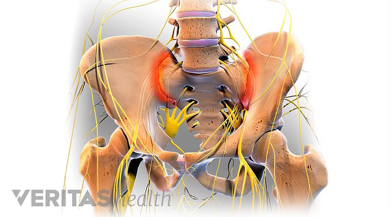 All About Sacroiliitis