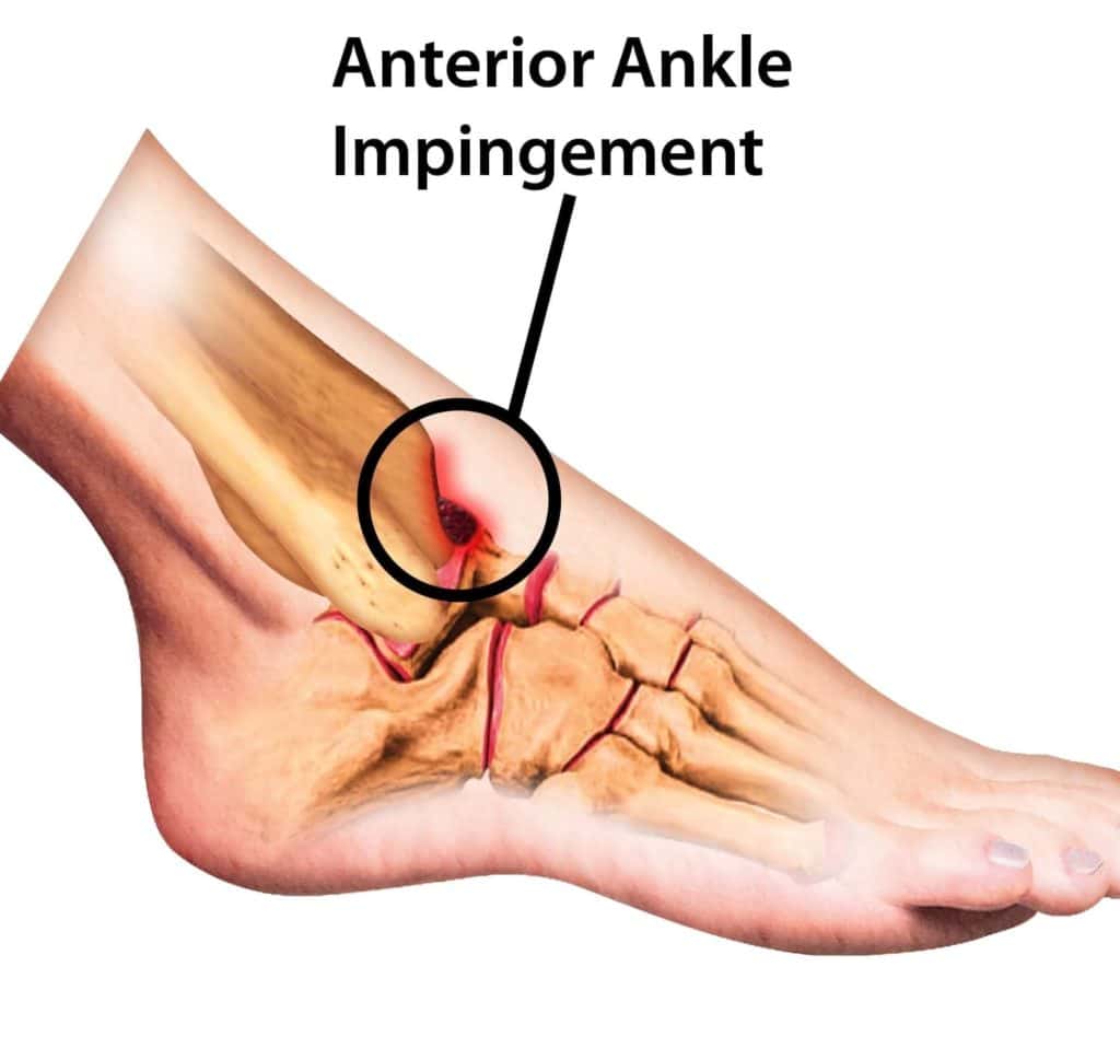 anterior ankle impingement : causes , symptoms , diagnosis &  treatment