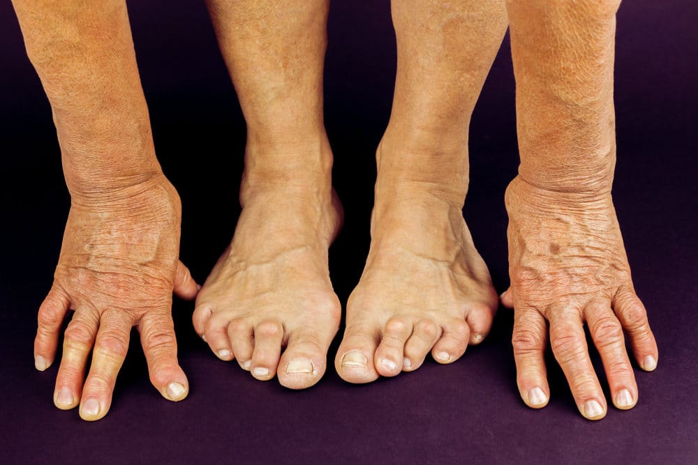Are Bunions and Arthritis Related?