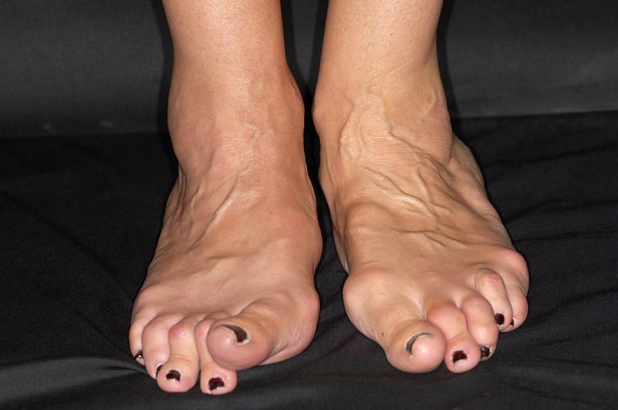 Arthritic Feet Photograph by Dr P. Marazzi/science Photo Library