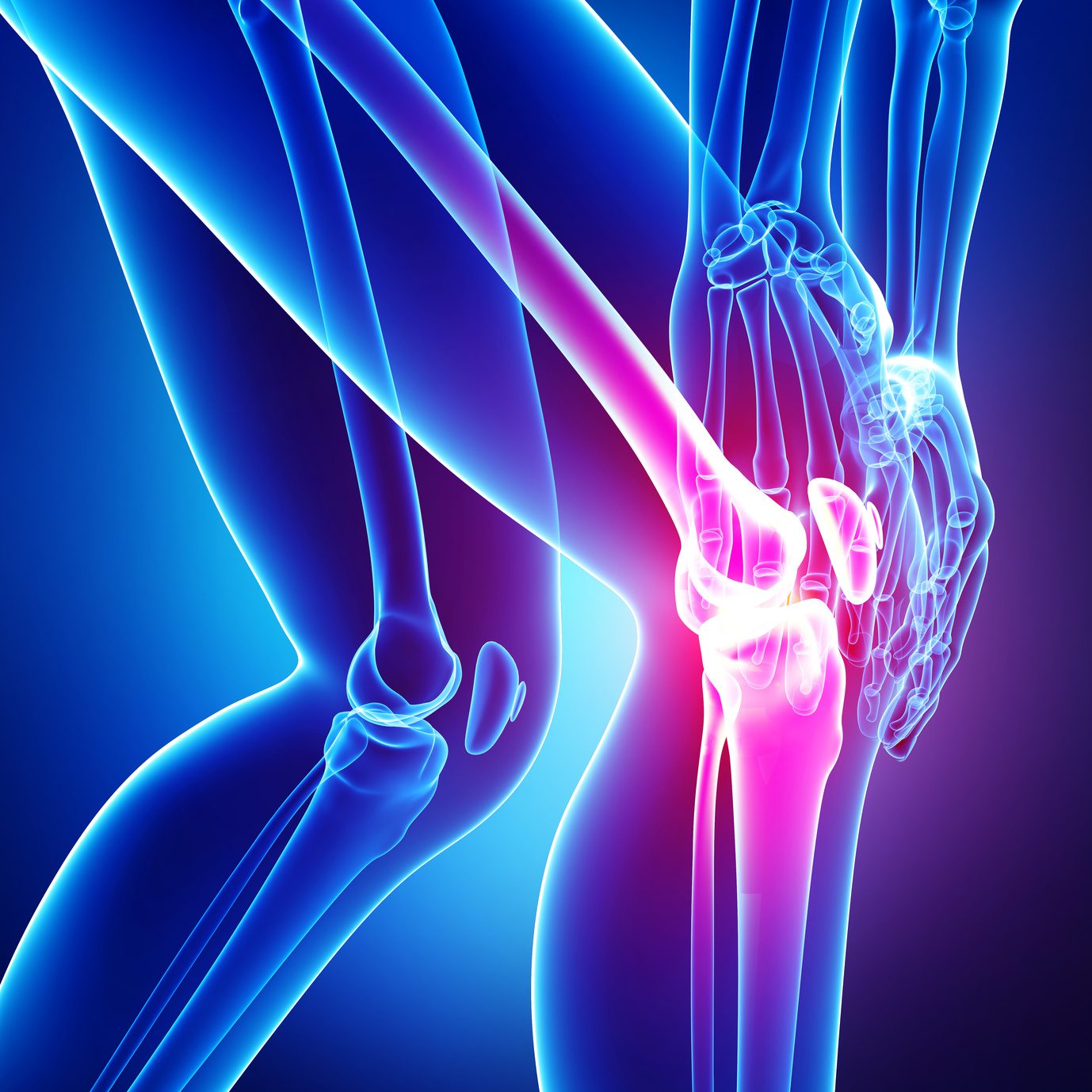 Arthritic Knee Pain