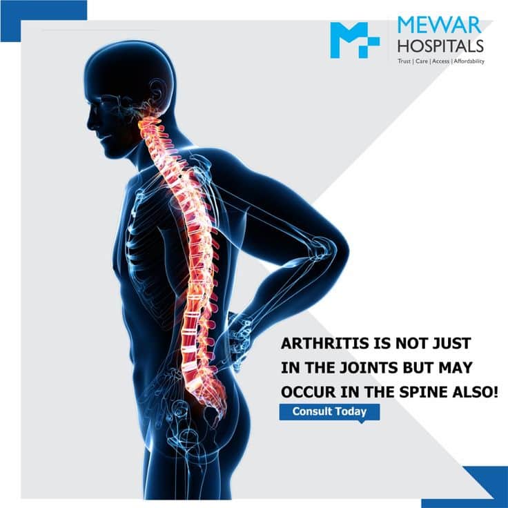 Arthritis can affect spine too !