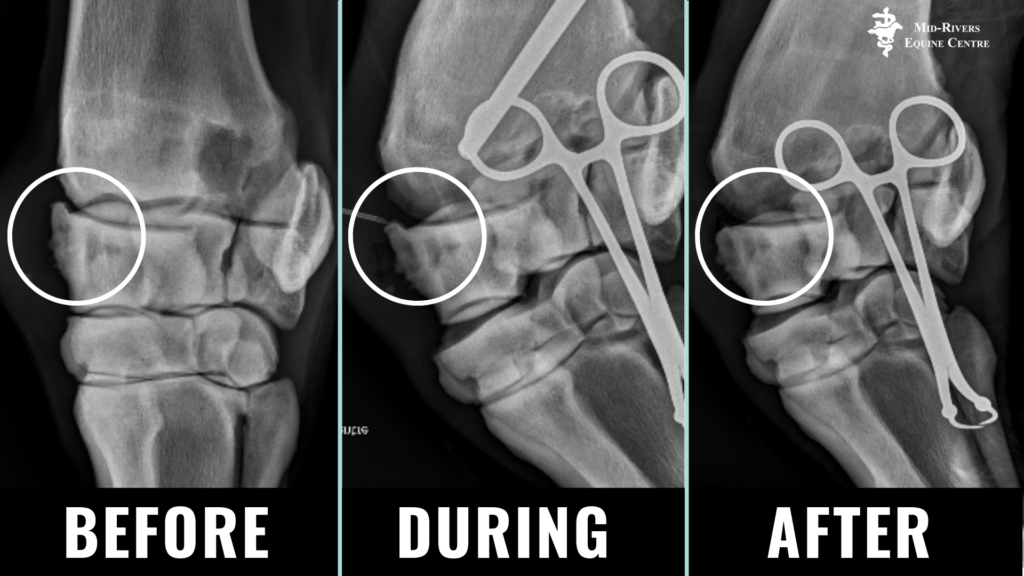Arthritis Cuases Bone Spurs