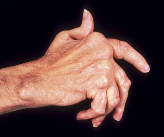 Arthritis formula reduces pain, swelling, increases ...