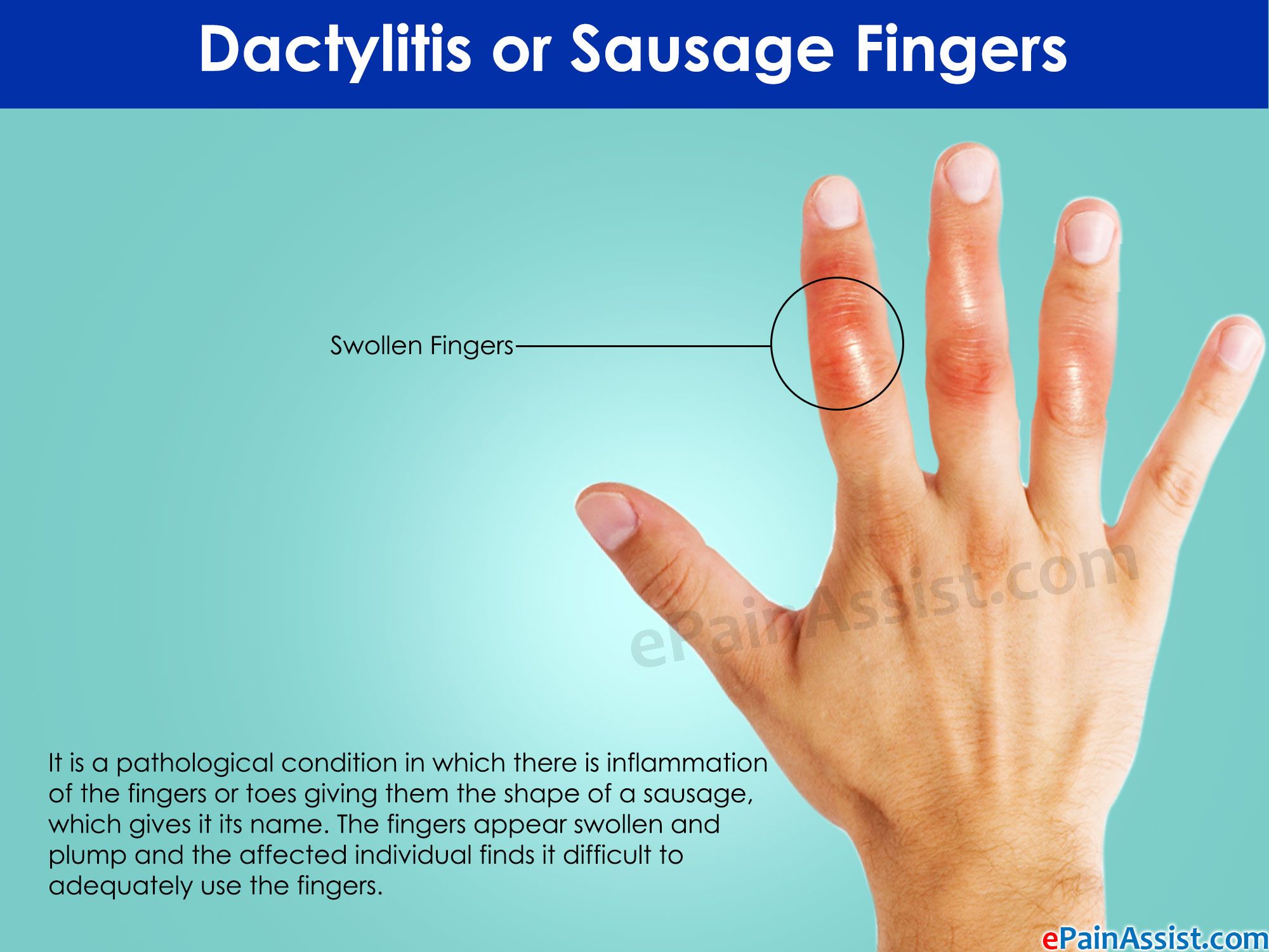Arthritis In Fingers Treatment