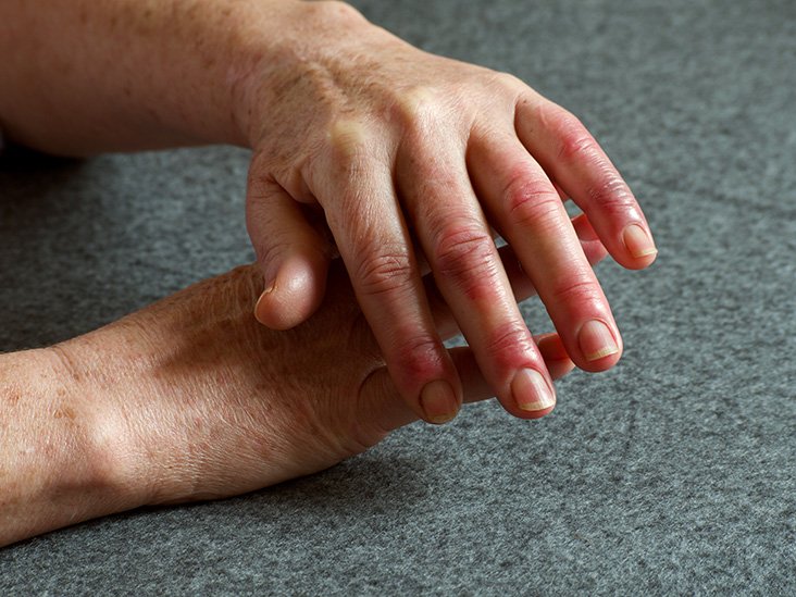Arthritis in fingers: What does it feel like? Causes and treatment