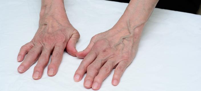 Arthritis in Hands: Causes, Symptoms, Treatment and More