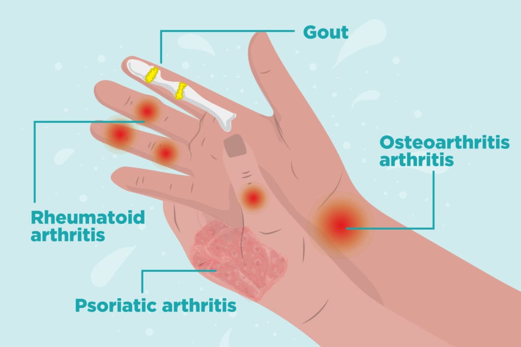 Arthritis in Hands: Symptoms, Types of Hand Arthritis, and ...