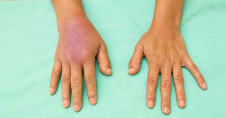Arthritis In Hands  Why You Should Be Concerned
