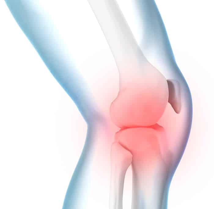 Arthritis in Knee