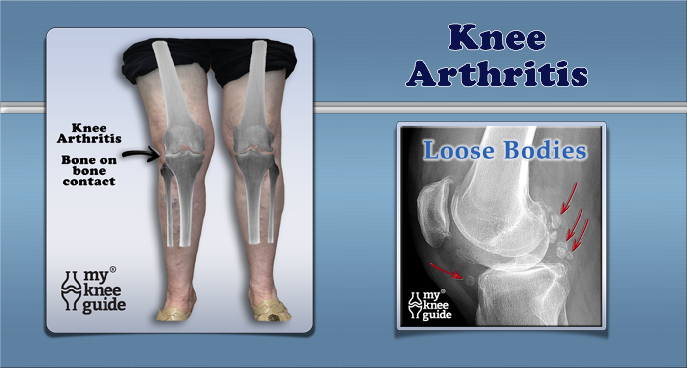 Arthritis In Knee X Ray