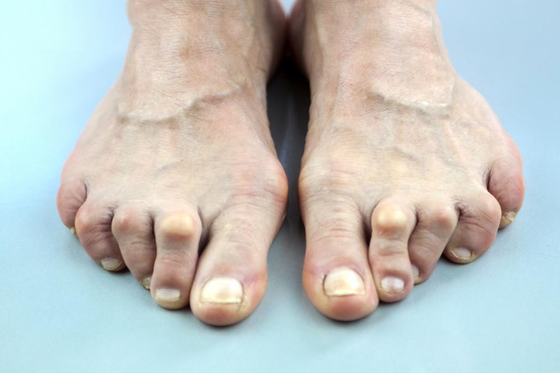 Arthritis in toes: Procedures and pain relief