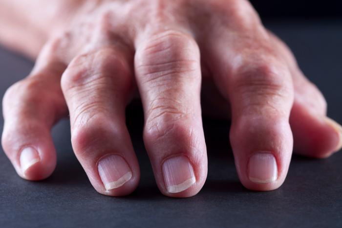 Arthritis mutilans: Symptoms, causes, and treatment
