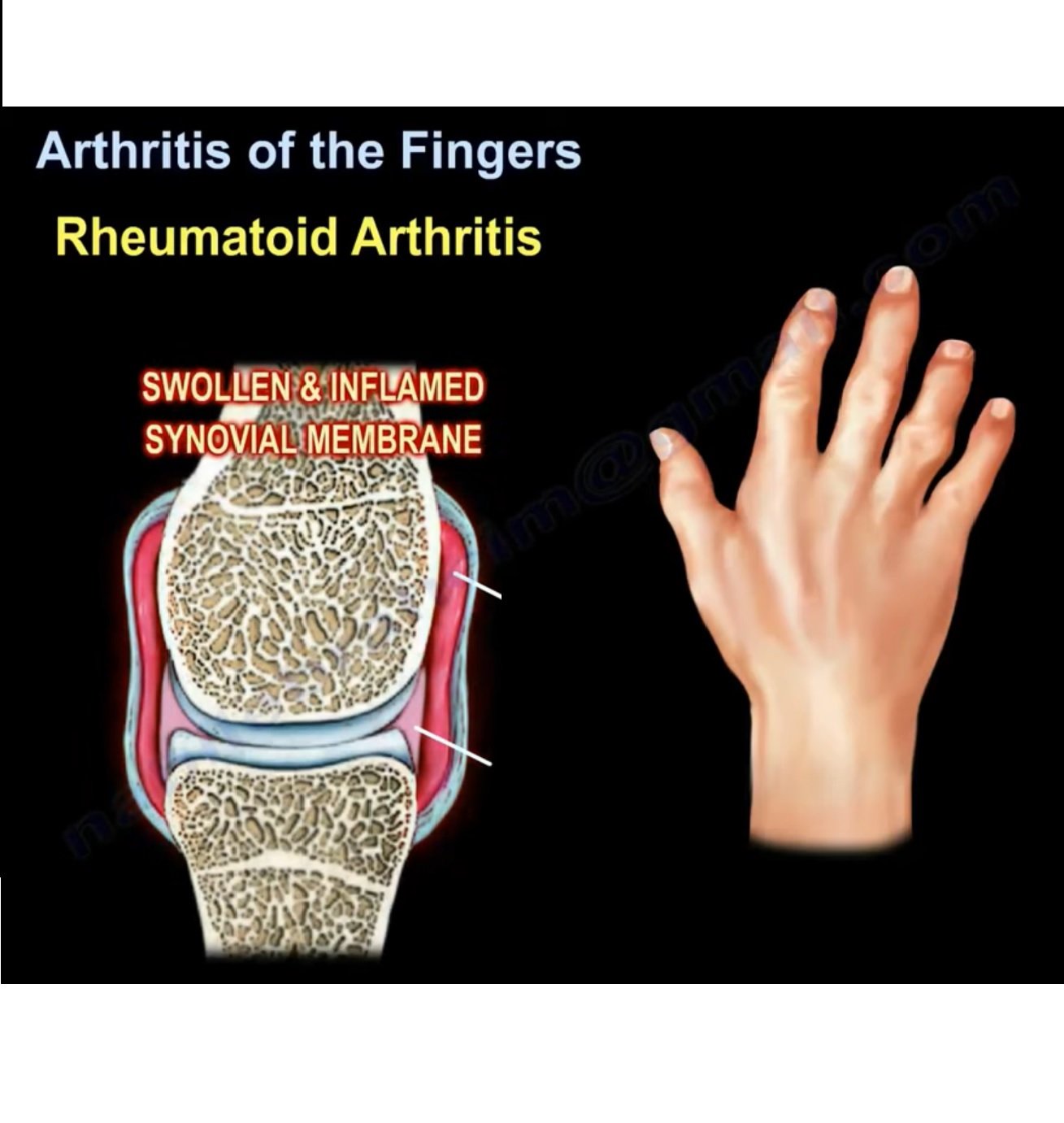 Arthritis of the Fingers  OrthopaedicPrinciples.com