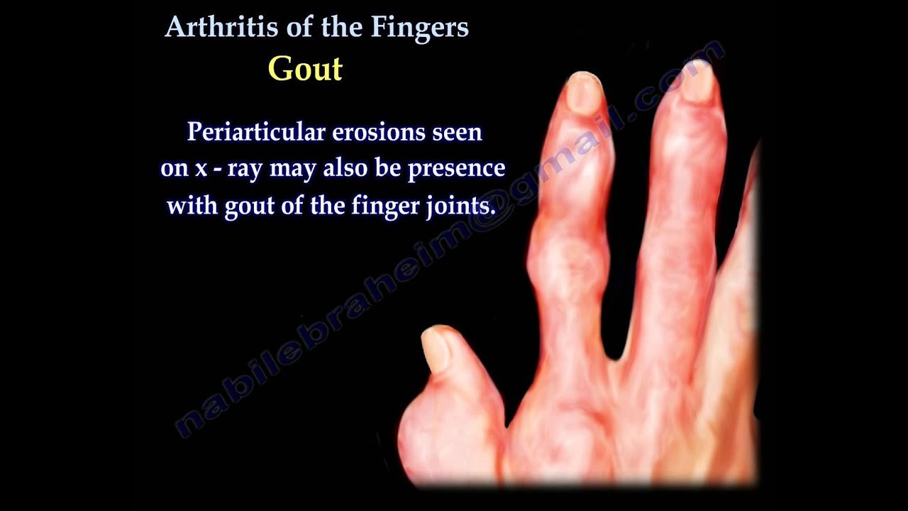 Arthritis Of The Fingers types and patterns