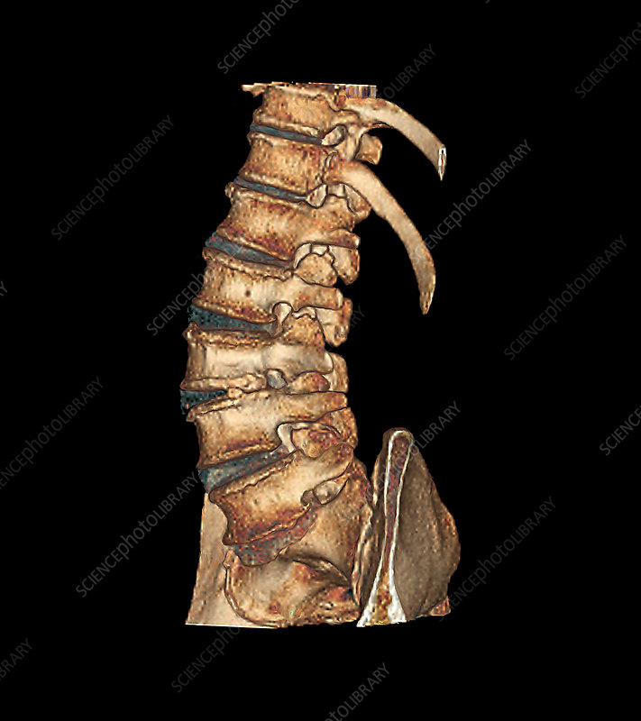 Arthritis of the spine, CT scan