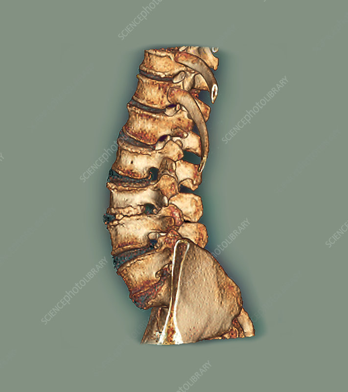 Arthritis of the spine, CT scan