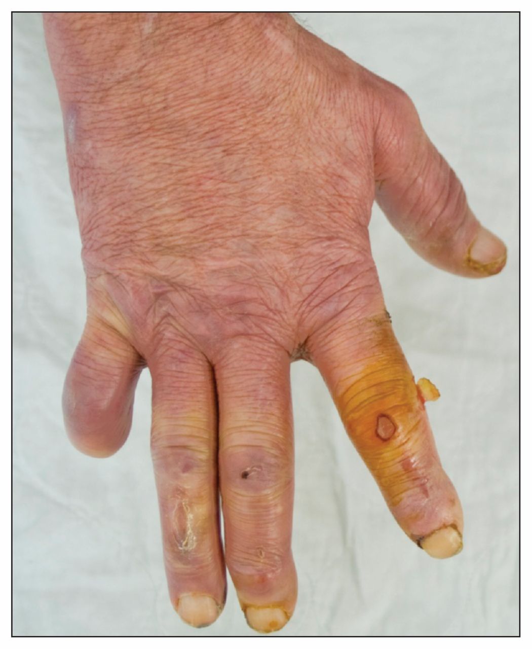 Arthritis, progressive maculopapular rash and severe peripheral ...
