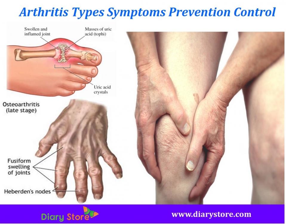 Arthritis Types Symptoms Prevention Control ...