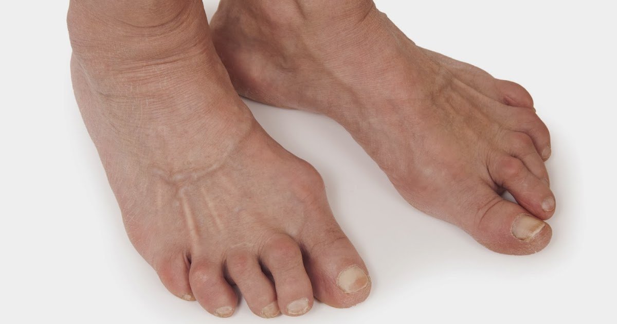 arthritishq: Rheumatoid Arthritis in Feet