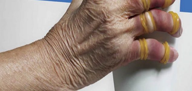 Beginning Signs Of Rheumatoid Arthritis In Hands