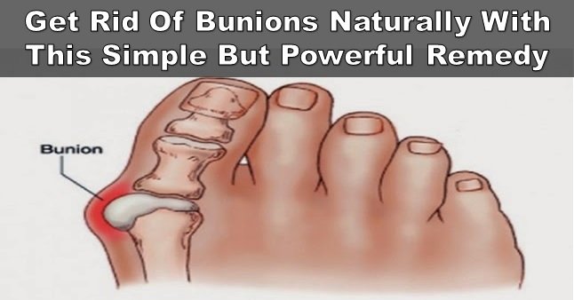 Best Home Remedies To Get Rid Of Feet Bunions